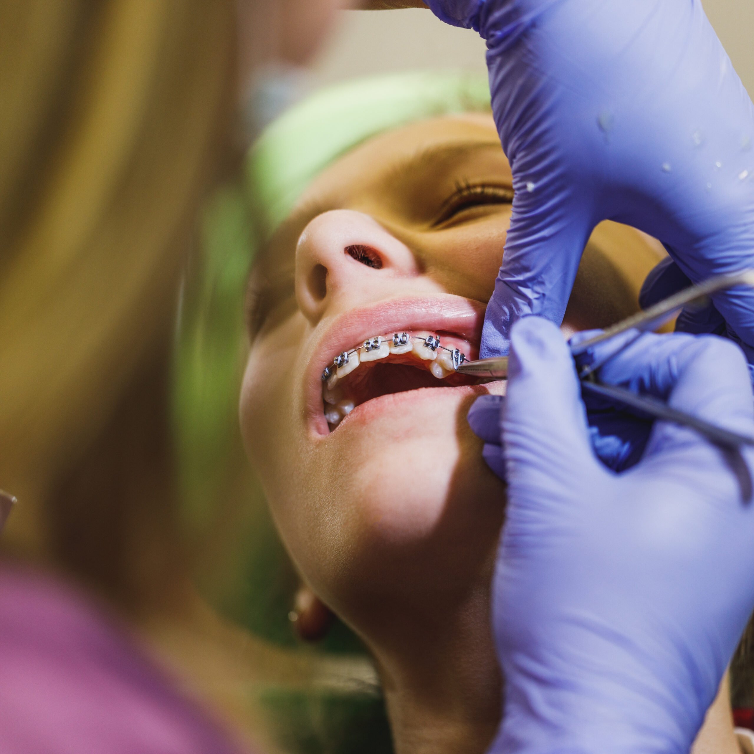 Braces Process scaled