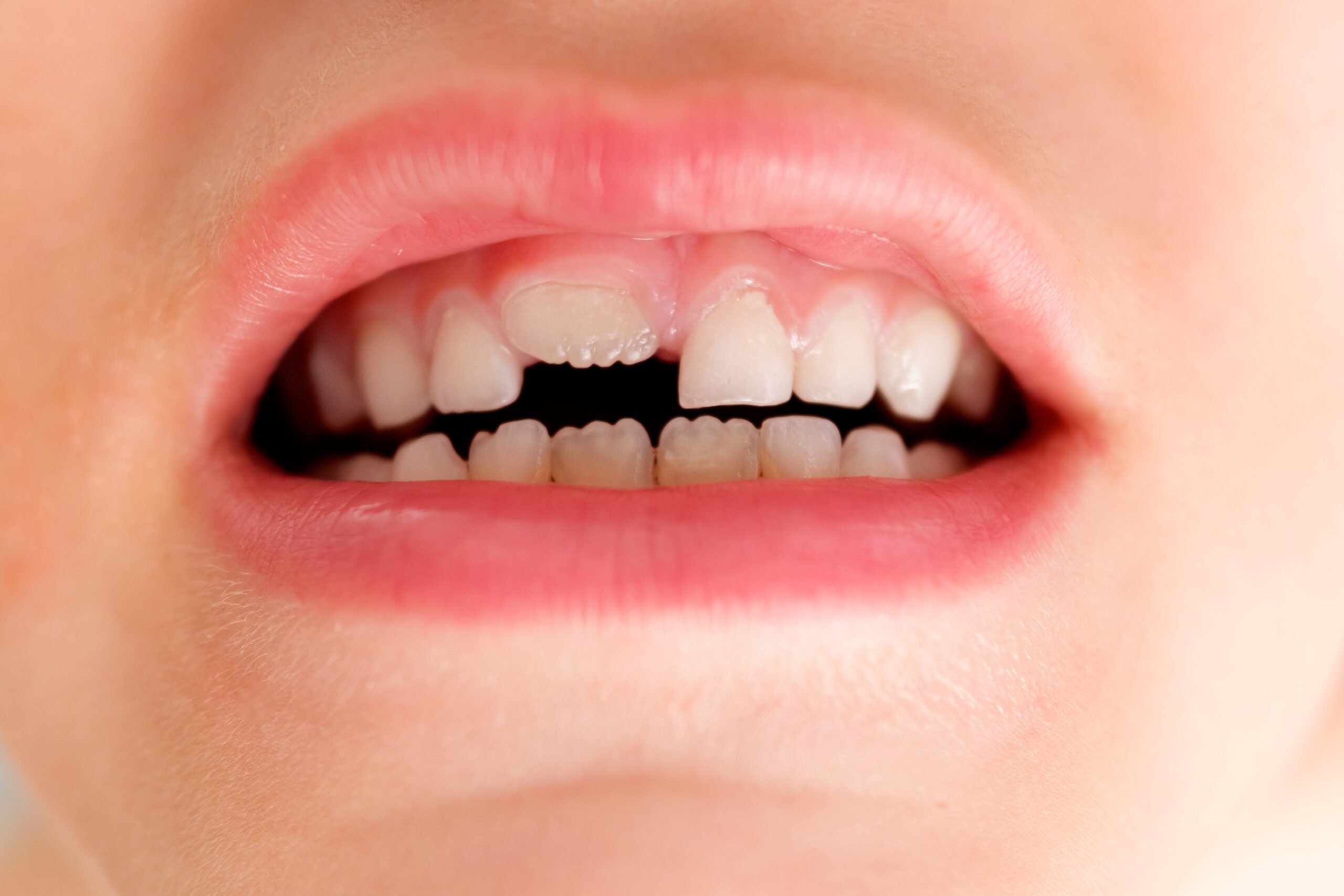 a child with an open mouth shows his new tooth 2023 11 27 05 05 01 utc scaled