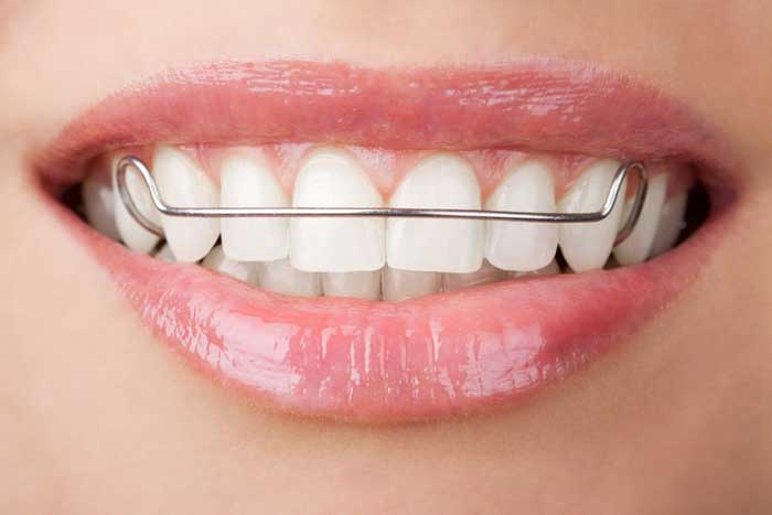 orthodontic treatment