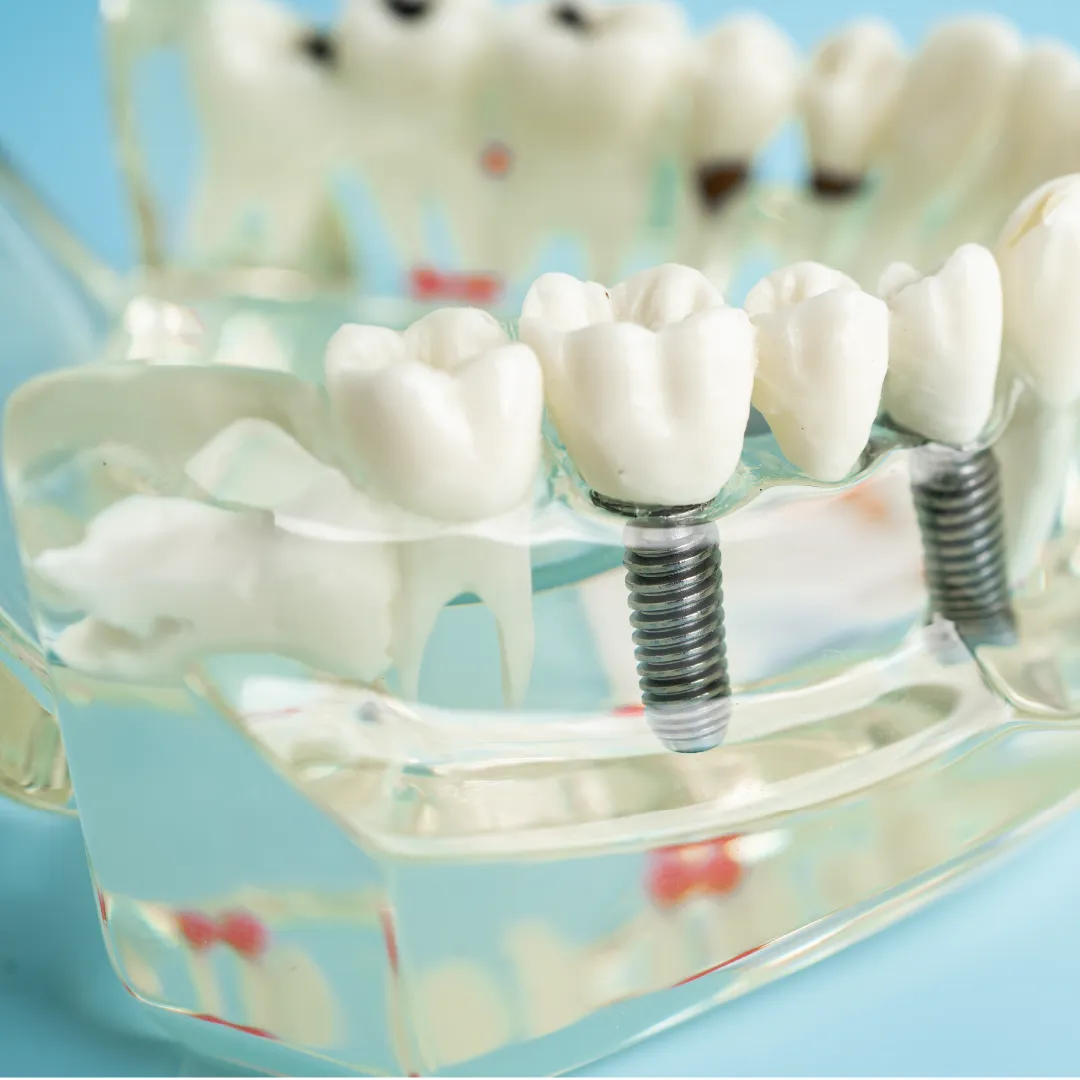 all for one dental implant alam impian