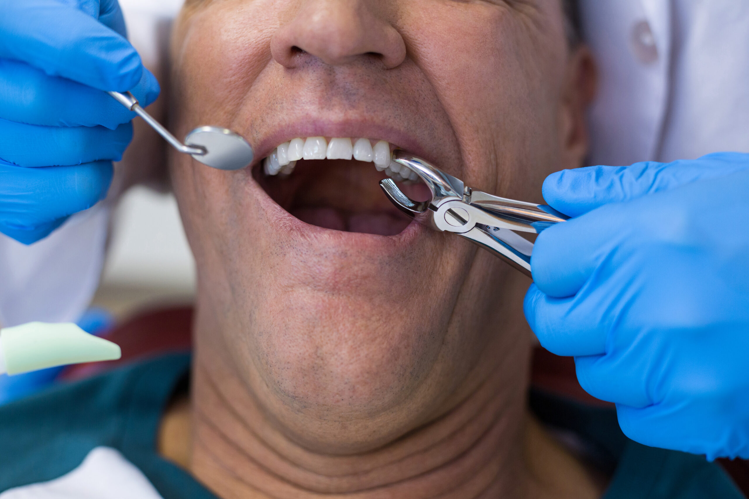 dentist using surgical pliers to remove a decaying 2023 11 27 04 50 12 utc scaled
