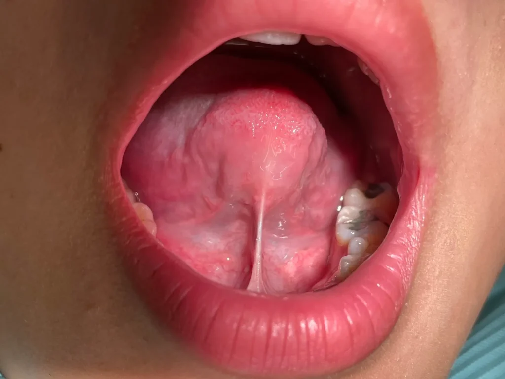 Baby Tongue Tie Treatment 1 tongue tied baby types of tongue tie alam impian