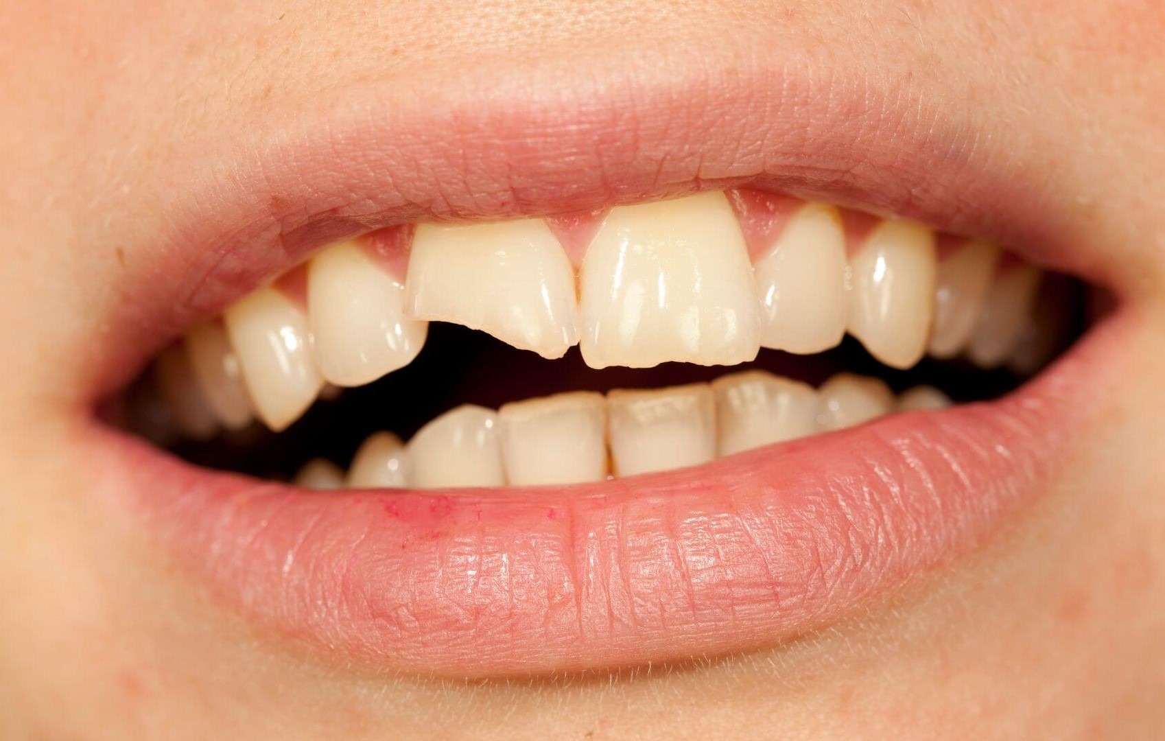 uncomplicated injuries dental trauma alam impian