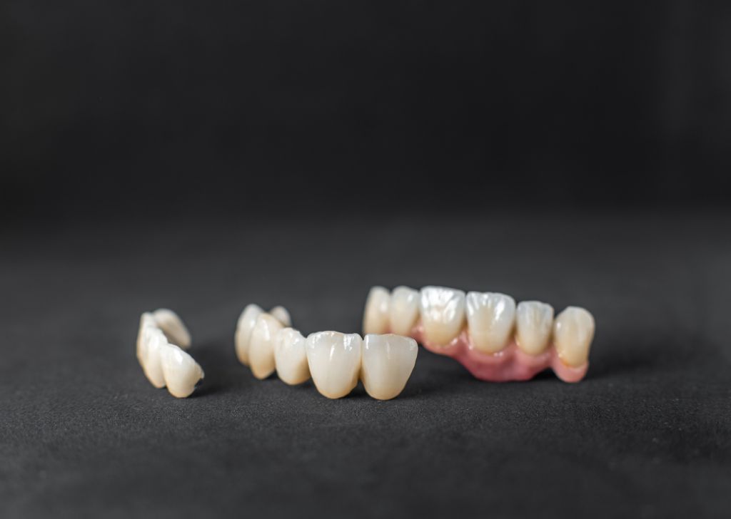 Dental Crown & Bridge in Alam Impian, Shah Alam