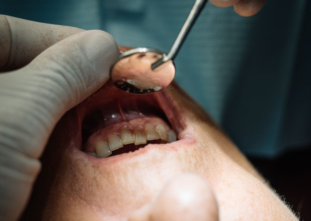 Dental Crown & Bridge in Alam Impian, Shah Alam
