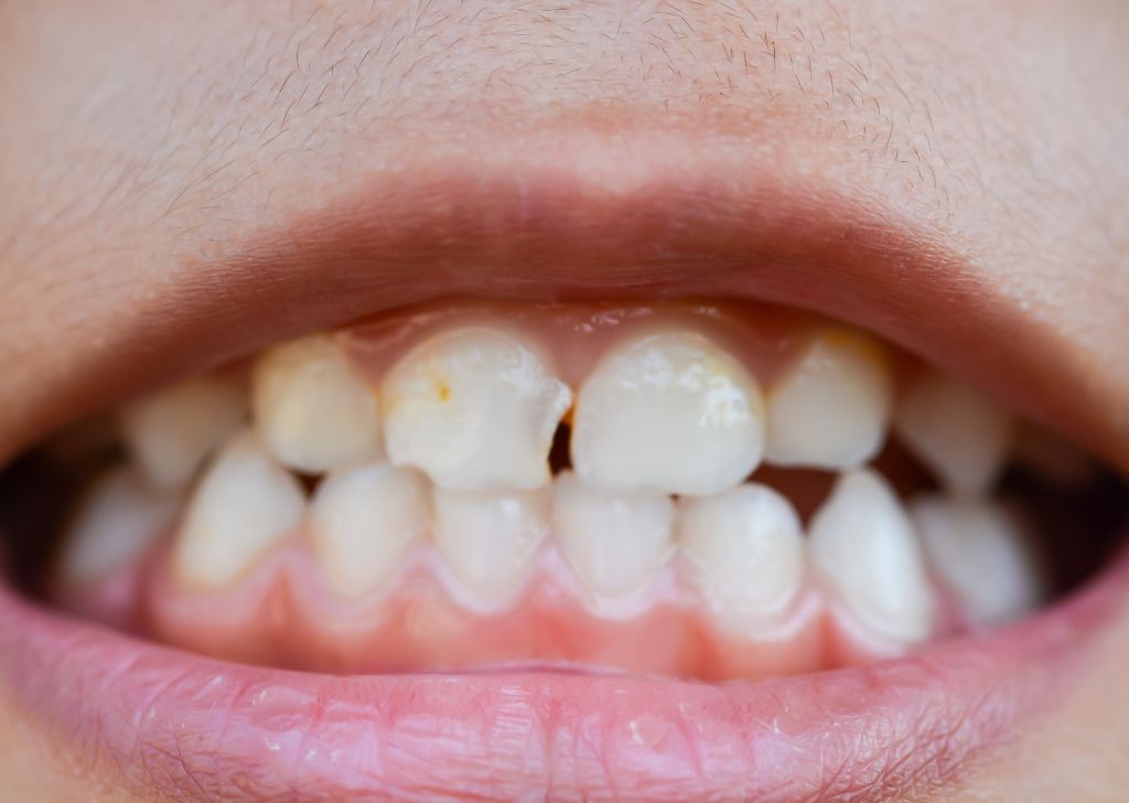 Dental Crown & Bridge in Alam Impian, Shah Alam